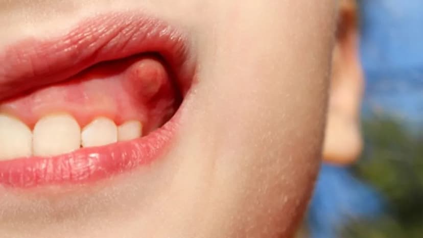 Nhận Biết Sớm Và Xử Lý Hiệu Quả Bệnh Ung Thư Ở Nướu Răng