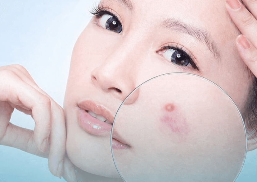 Mụn là gì? Cách điều trị và phòng ngừa
