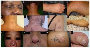 Sarcoidosis là gì? Triệu chứng, nguyên nhân và phương pháp điều trị hiệu quả