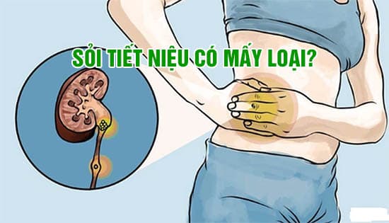 Sỏi tiết niệu là gì? Dấu hiệu, nguyên nhân, chẩn đoán và điều trị