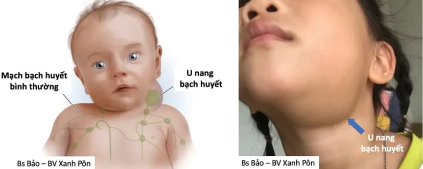 U bạch huyết là gì? Những điều cha mẹ cần biết
