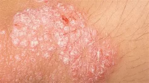 Bệnh Chàm Là Gì? Nguyên Nhân, Triệu Chứng Và Cách Điều Trị Hiệu Quả