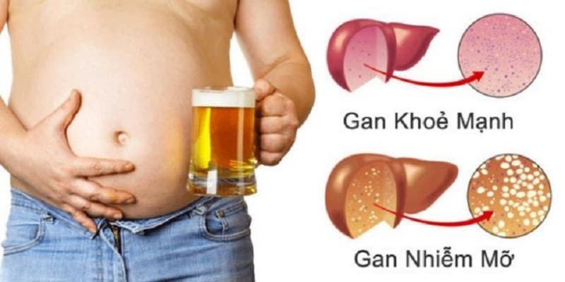 Bệnh gan do rượu là gì? Những điều cần biết về bệnh gan do rượu