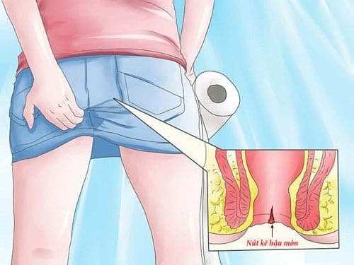Viêm hậu môn là gì? Những điều cần biết về viêm hậu môn