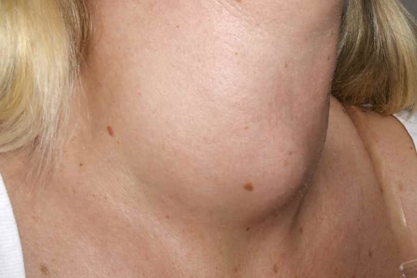 Bướu giáp đa nhân là gì? Những điều cần biết về bướu giáp đa nhân