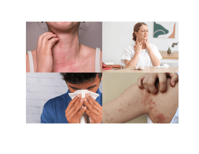 Bệnh dị ứng là gì? Nguyên nhân, triệu chứng và phân loại bệnh dị ứng.