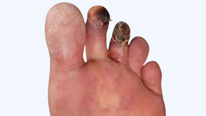 Bệnh Buerger là gì? Những điều cần biết về bệnh Buerger