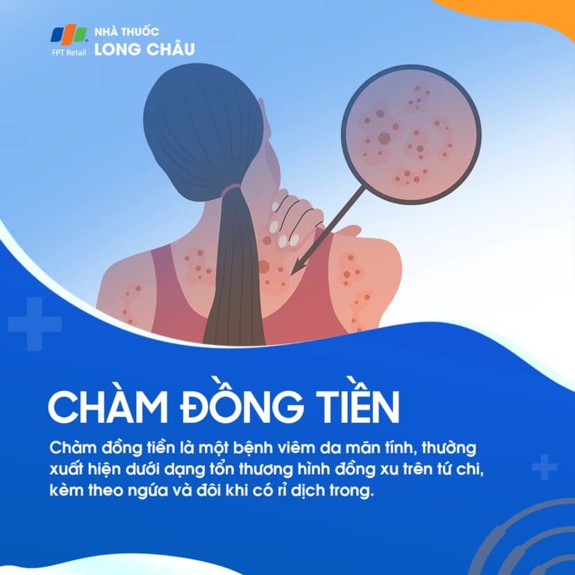 Chàm đồng tiền: Nguyên nhân, triệu chứng, phương pháp điều trị