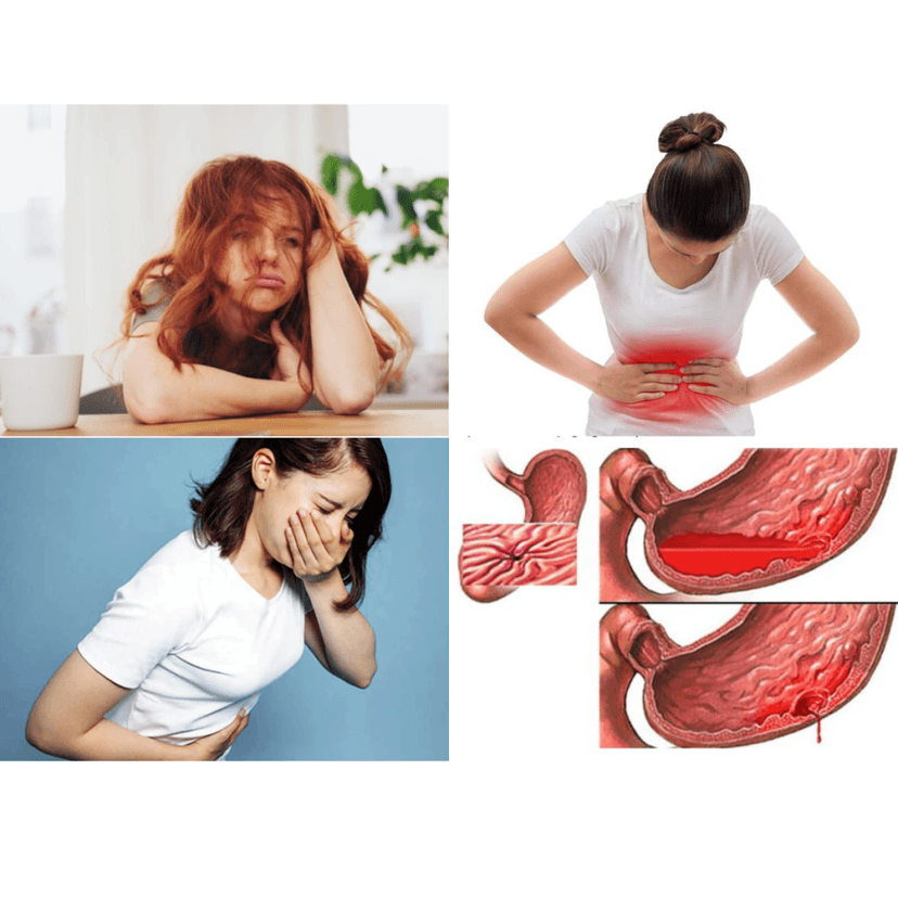 U mô đệm đường tiêu hóa (GISTs) là gì? Những điều mà bạn cần biết về bệnh này