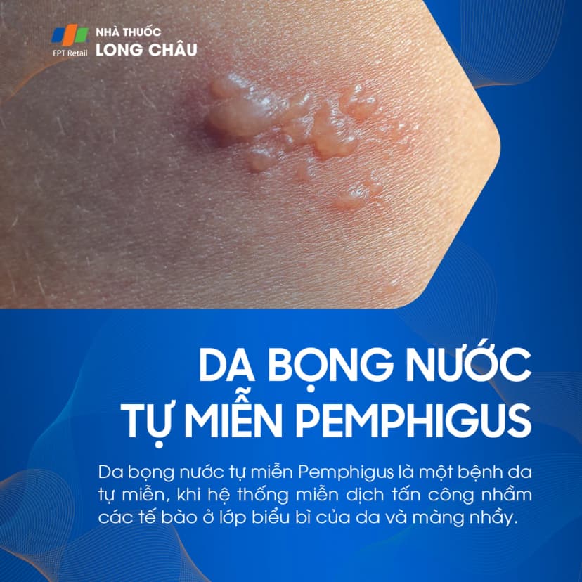 Da bọng nước tự miễn Pemphigus là gì? Nguyên nhân và cách điều trị