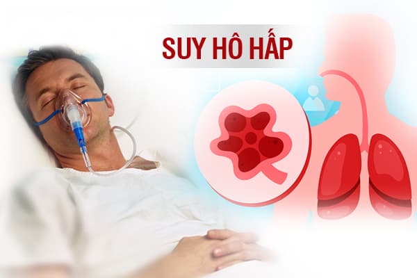 Suy hô hấp mạn là gì? Những điều cần biết về suy hô hấp mạn