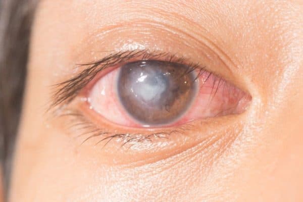 Loét giác mạc là gì? Dấu hiệu, nguyên nhân, chẩn đoán và điều trị