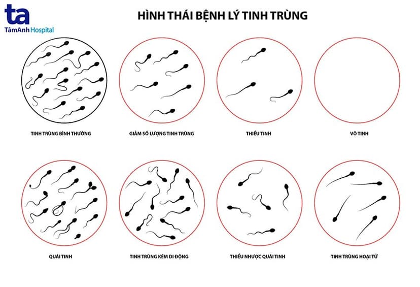 Không có tinh trùng là gì? Nguyên nhân, triệu chứng và phương pháp điều trị