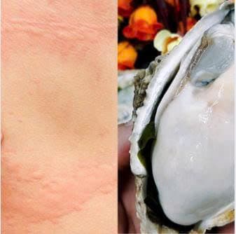 Dị Ứng Hải Sản: Nguyên Nhân, Triệu Chứng, Cách Xử Lý và Phòng Ngừa