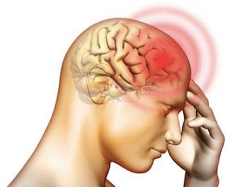 Phù não là gì? Những điều cần biết về phù não