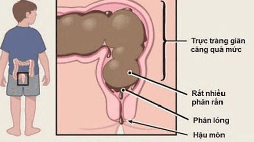 Són phân là gì? Nguyên nhân, triệu chứng, chẩn đoán và cách điều trị hiệu quả