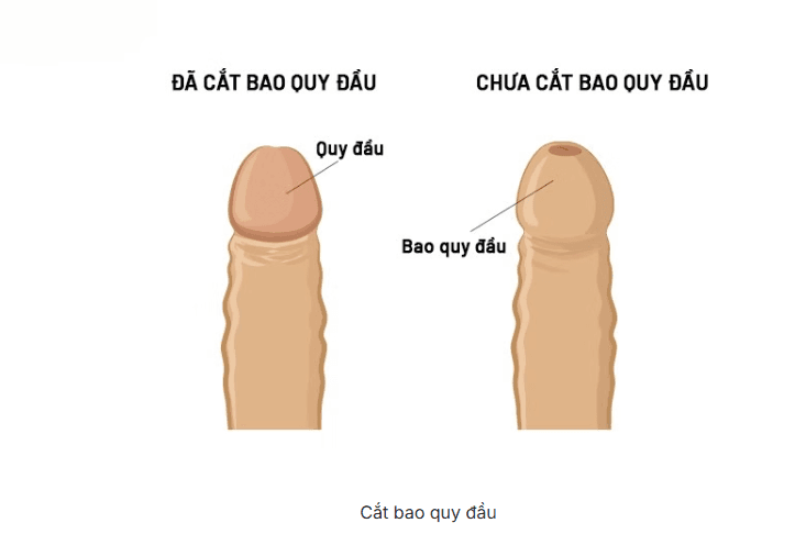 Bán hẹp bao quy đầu là gì? Những điều cần biết về bán hẹp bao quy đầu